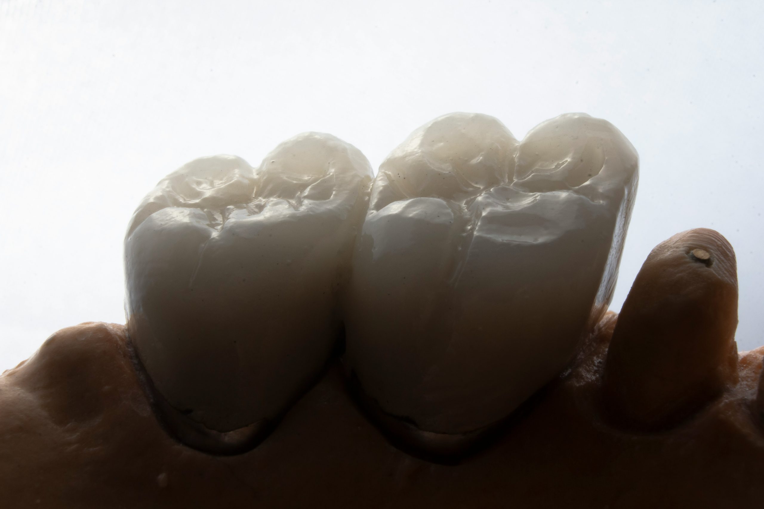 Temporary Dental Crowns in Albemarle, NC